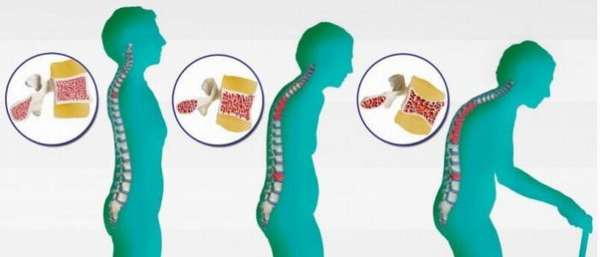 Симптомы и лечение системного остеопороза